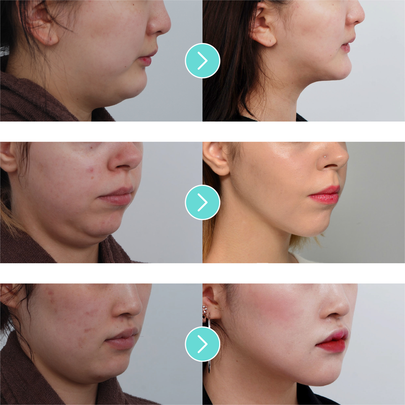 Korean Fox Face Shaping Surgery - V-line Face Liposuction - Eunogo Shop