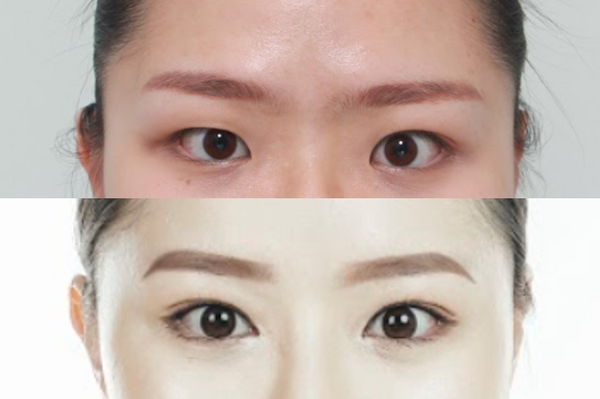 The Complete Guide to Korean Double Eyelid Surgery
