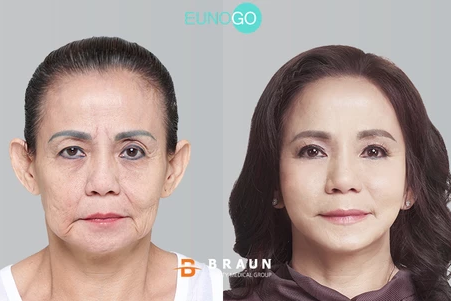 Jessica Iskandar and Mom: Mrs Woen's Korean Anti-Aging Makeover Story