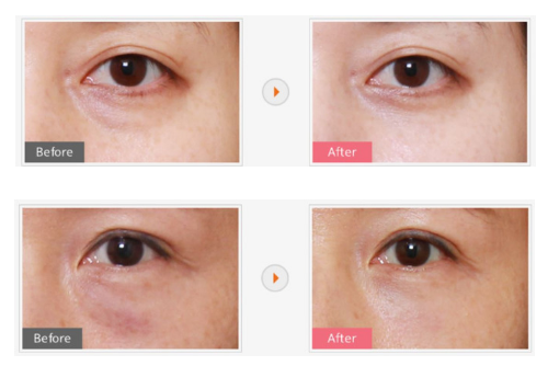 All You Need To Know About Eyebag Removal Surgery In Korea