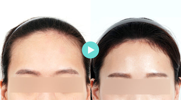 Everything You Need to Know About Forehead Reduction Surgery