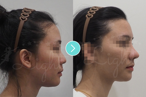 What is Korean Mesh Rhinoplasty? Advantages, Side Effects, Results and Many More