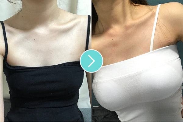 Tips to ensure natural results after breast augmentation surgery