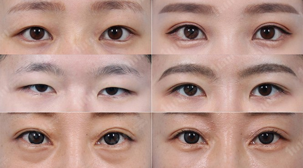 Korean Double Eyelids Surgery: Guide To Different Surgical Methods