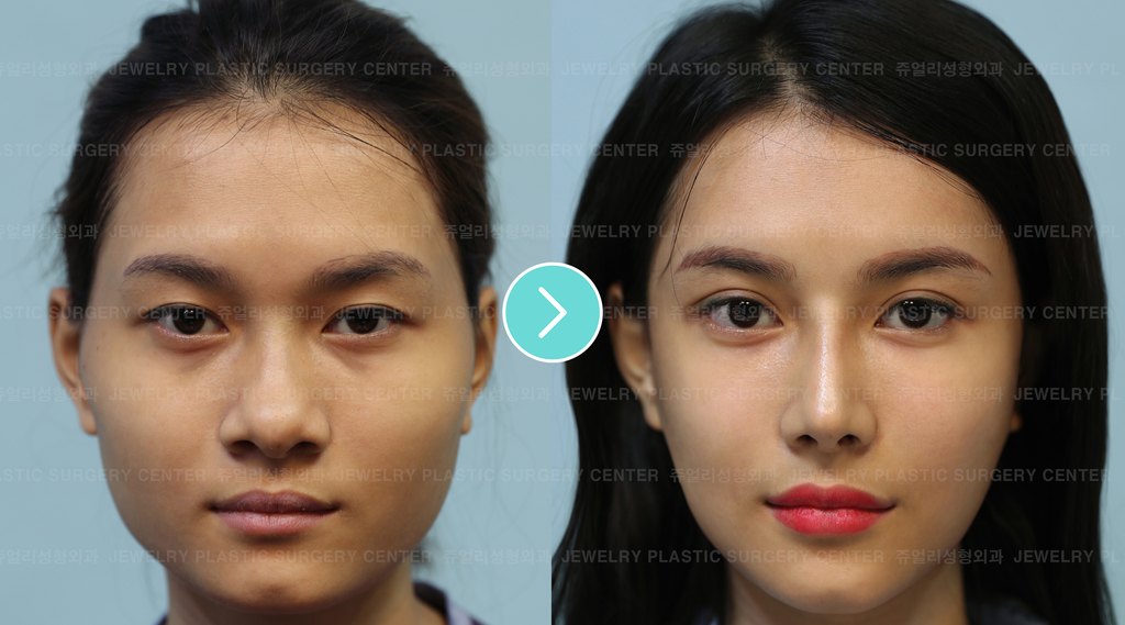 Is Facial Contouring Surgery Right for You? Advice from a Korean Plast –  Eunogo