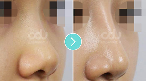 What You Need to Know About Rhinoplasty in Korea
