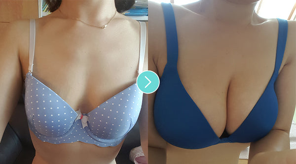 Breast Augmentation Surgery For Saggy Breasts?