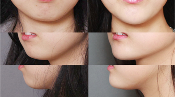 A Complete Guide to Chin Augmentation and Implant Surgery