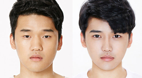 Plastic Surgery for Men: The Latest Trends in Korea