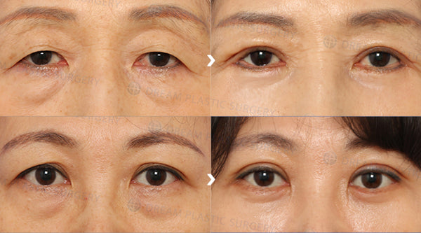 All About Blepharoplasty (Eye Lift): The Most Commonly Done Anti-Aging Plastic Surgery