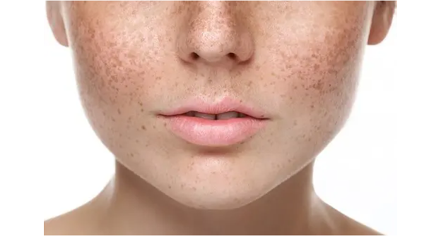 Laser Treatments for Freckles and Blemishes