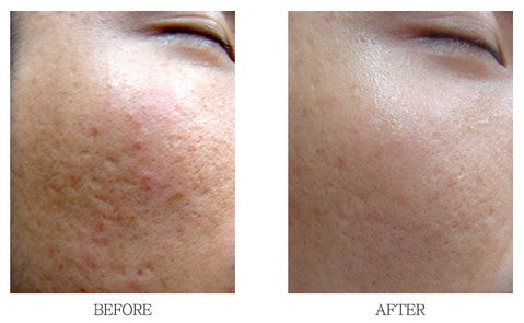 How a top Korean dermatologist treats pores