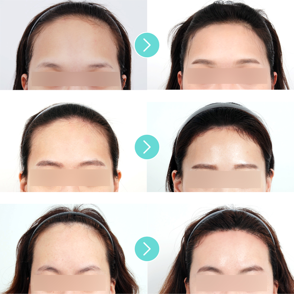 Forehead Reduction Surgery - Eunogo Shop